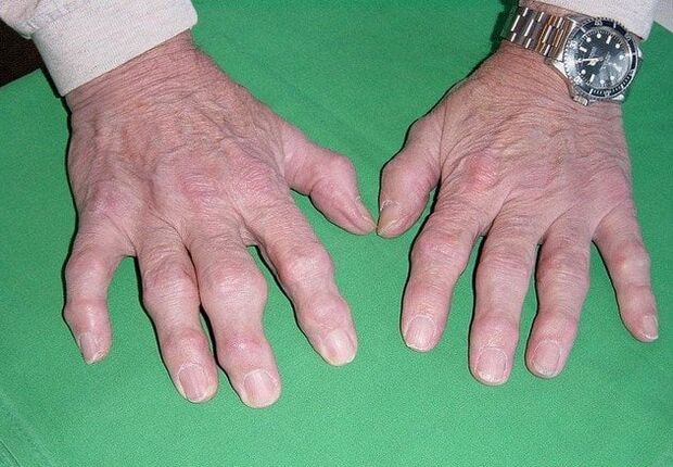 Arthrose der Finger