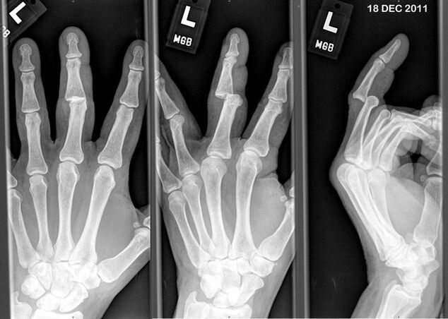 Röntgenaufnahme der ausgerenkten Finger