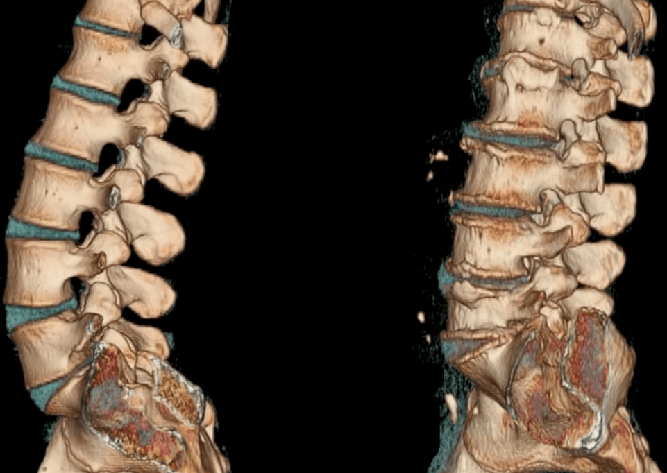 Osteochondrose