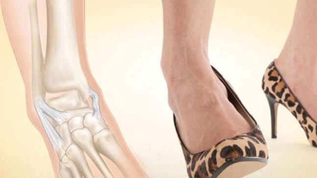 Tragen von Schuhen mit Absätzen als Ursache für Arthrose des Sprunggelenks