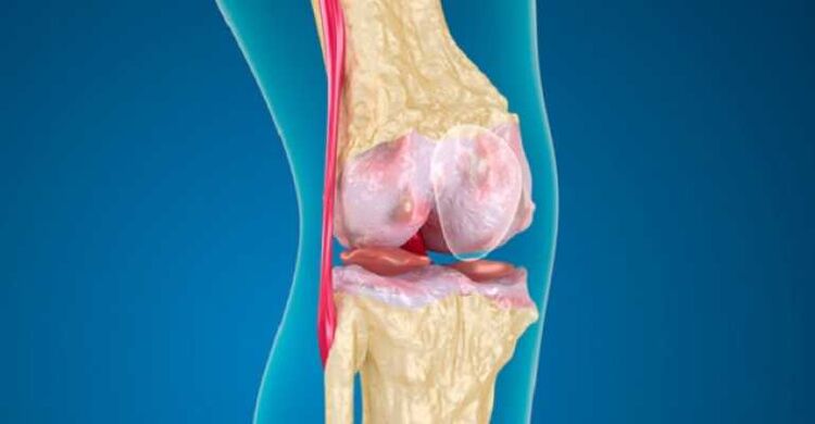 Arthrose der Kniegelenkkrankheit, die die Zerstörung von Knorpel in den Gelenken verursacht