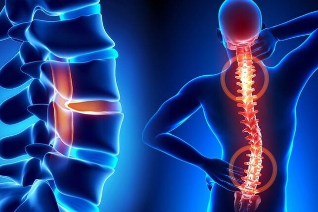 Osteochondrose der Wirbelsäule